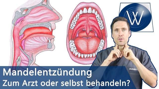 Effektive Maßnahmen zur Linderung geschwollener Mandeln Trinken