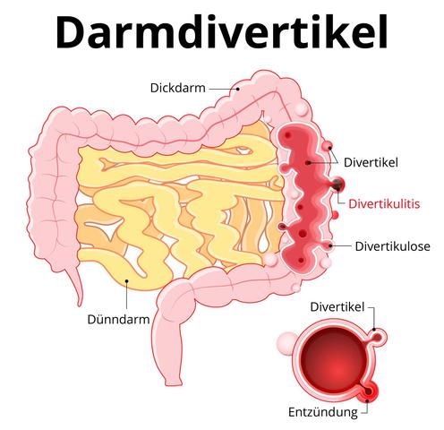 Sigmadivertikulose Ursachen Symptome und Behandlungsmöglichkeiten