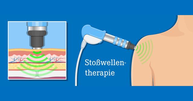 Sto Wellentherapie Selbstbehandlung Versus Professionelle Behandlung