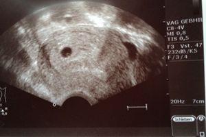 Ab wann kann man den Embryo in der Fruchthöhle erkennen? Der richtige Zeitpunkt für den ersten Ultraschall Ab wann kann man den Embryo in der Fruchthöhle erkennen? Der richtige Zeitpunkt für den ersten Ultraschall