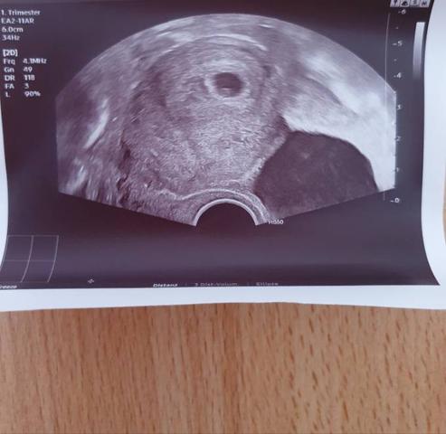 Der erste Ultraschall: Wann kann man den Embryo in der Fruchthöhle sehen? Der erste Ultraschall: Wann kann man den Embryo in der Fruchthöhle sehen?