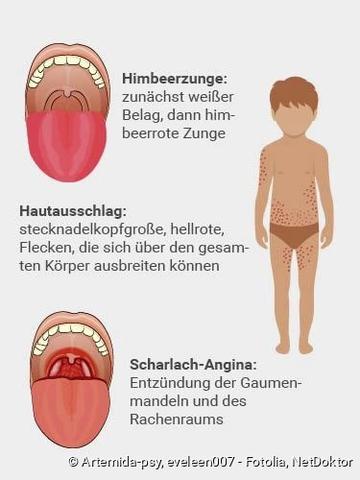 Die Ansteckungszeit bei Scharlach: Ab wann besteht Gefahr für andere? Die Ansteckungszeit bei Scharlach: Ab wann besteht Gefahr für andere?