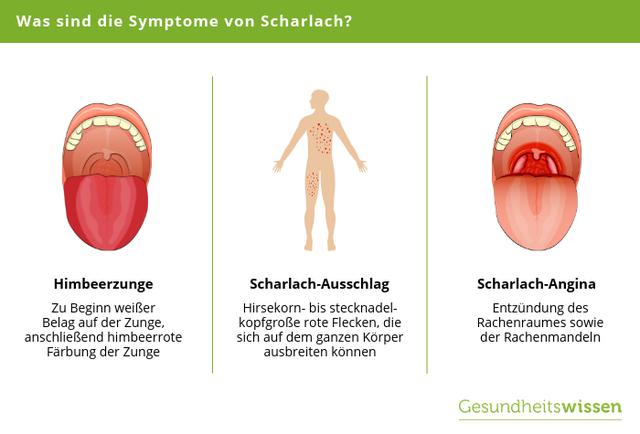 Scharlach-Ansteckung: Zeitpunkt und Übertragungswege im Fokus Scharlach-Ansteckung: Zeitpunkt und Übertragungswege im Fokus