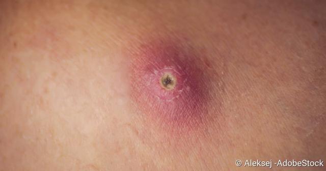 Was tun, wenn ein Abszess geplatzt ist?