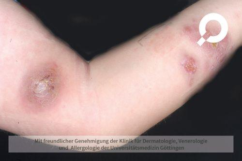 Behandlung nach dem Aufgehen eines Abszesses