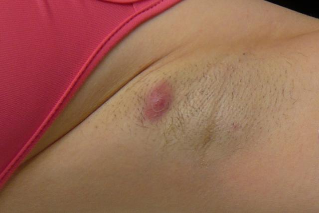 Abszess in Deutschland: Optimierungsbedarf bei der Versorgung von Akne inversa-Patienten Abszess in Deutschland: Optimierungsbedarf bei der Versorgung von Akne inversa-Patienten