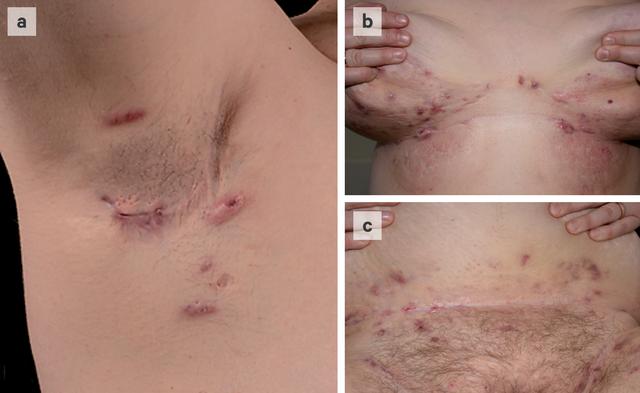 Akne inversa: Chronische Erkrankung mit starkem Einfluss auf die Lebensqualität Akne inversa: Chronische Erkrankung mit starkem Einfluss auf die Lebensqualität