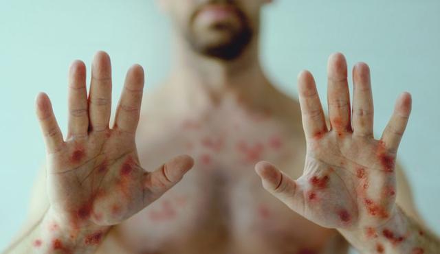 Affenpocken: Eine seltene Viruserkrankung mit Verbindung zu Menschen- und Kuhpockenviren