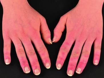 Gefahren für die Akren: Kälteeinwirkung und Sauerstoffmangel