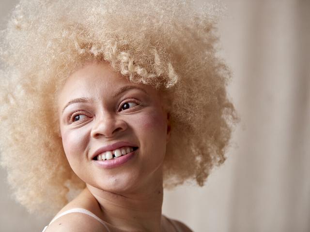 Albinismus und Sehbehinderungen: Wie beeinflusst die Erbkrankheit das Sehvermögen? Albinismus und Sehbehinderungen: Wie beeinflusst die Erbkrankheit das Sehvermögen?