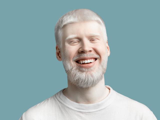 Albinismus und psychische Auswirkungen: Die Herausforderungen für Betroffene Albinismus und psychische Auswirkungen: Die Herausforderungen für Betroffene