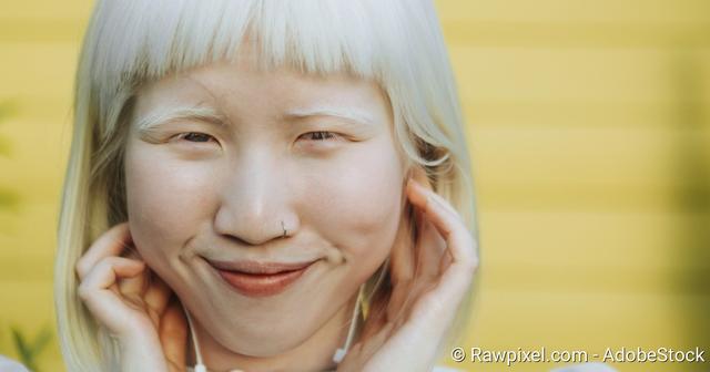 Albinismus: Ursachen, Symptome und Behandlungsmöglichkeiten Albinismus: Ursachen, Symptome und Behandlungsmöglichkeiten