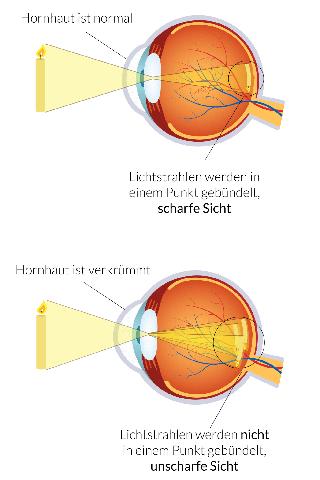 Irregulärer Astigmatismus: Ursachen und Behandlungsmöglichkeiten