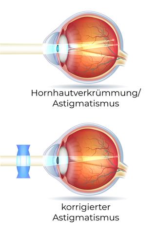 Astigmatismus: Eine häufige Form der Fehlsichtigkeit