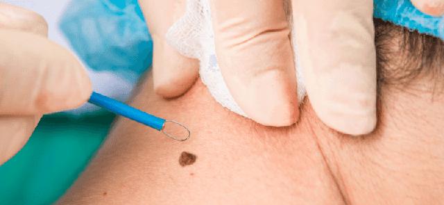 Sicher entfernen: Methoden zur risikofreien Entfernung von Muttermalen und Leberflecken Sicher entfernen: Methoden zur risikofreien Entfernung von Muttermalen und Leberflecken