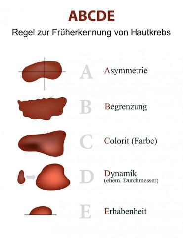Hautkrebsfrüherkennung: Wichtige Maßnahmen zur regelmäßigen Kontrolle Hautkrebsfrüherkennung: Wichtige Maßnahmen zur regelmäßigen Kontrolle