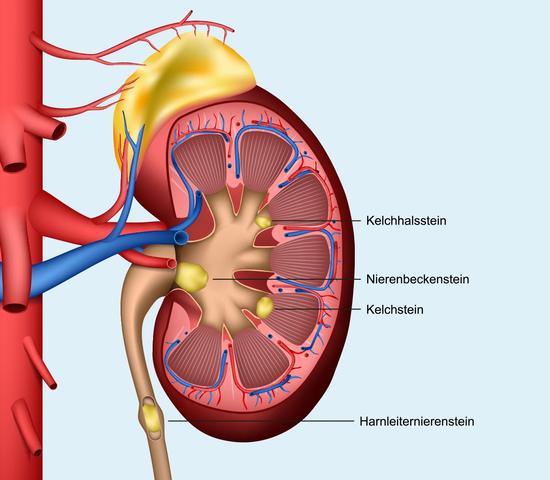 Diagnose von Nierensteinen: Wie werden sie festgestellt? Diagnose von Nierensteinen: Wie werden sie festgestellt?