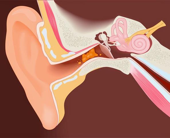 Auswirkungen einer falschen Reinigung von Ohrenschmalz auf die Hörqualität Auswirkungen einer falschen Reinigung von Ohrenschmalz auf die Hörqualität