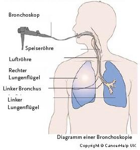 3. Der Ablauf einer Bronchoskopie: Was erwartet den Patienten? 3. Der Ablauf einer Bronchoskopie: Was erwartet den Patienten?