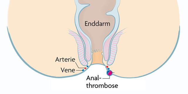 Wann ist ein Arztbesuch bei Analthrombose notwendig? Wann ist ein Arztbesuch bei Analthrombose notwendig?