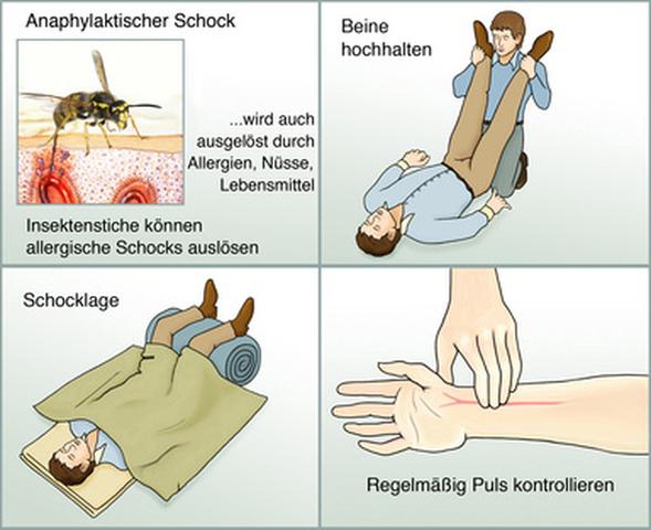 Anaphylaktischer Schock: Ursachen, Symptome und wie man reagieren sollte Anaphylaktischer Schock: Ursachen, Symptome und wie man reagieren sollte