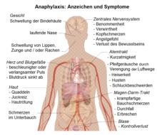 Anaphylaktischer Schock: Ursachen, Symptome und Notfallmaßnahmen Anaphylaktischer Schock: Ursachen, Symptome und Notfallmaßnahmen