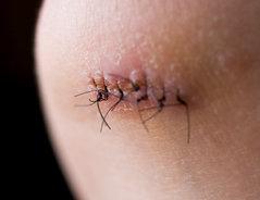 Fäden selber ziehen: Tipps und Anleitung für eine reizlose Wunde Fäden selber ziehen: Tipps und Anleitung für eine reizlose Wunde