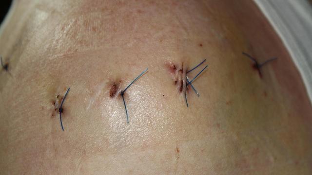 Selbst Fäden ziehen: Anleitung für kleine, gut verheilte Wunden Selbst Fäden ziehen: Anleitung für kleine, gut verheilte Wunden