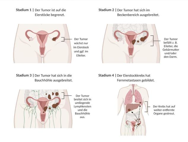 Frühe Anzeichen von Eierstockkrebs: Wie man die Krankheit rechtzeitig erkennt