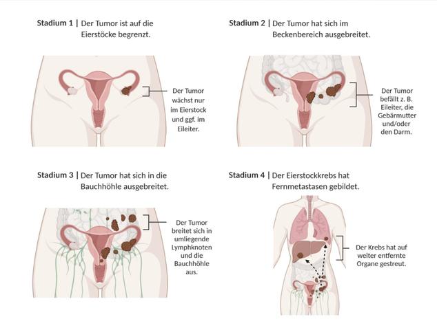 Eierstockkrebs: Anzeichen und Symptome, die Sie nicht ignorieren sollten