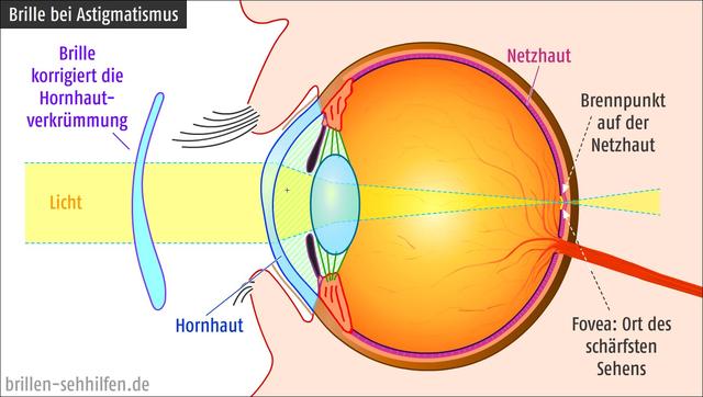 Astigmatismus: Eine häufige Form der Fehlsichtigkeit Astigmatismus: Eine häufige Form der Fehlsichtigkeit