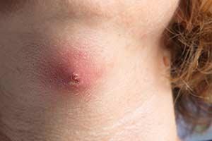 Alles über Atherome: Definition, Merkmale und mögliche Komplikationen