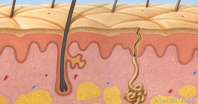 Atherom: Ursachen, Symptome und Behandlungsmöglichkeiten