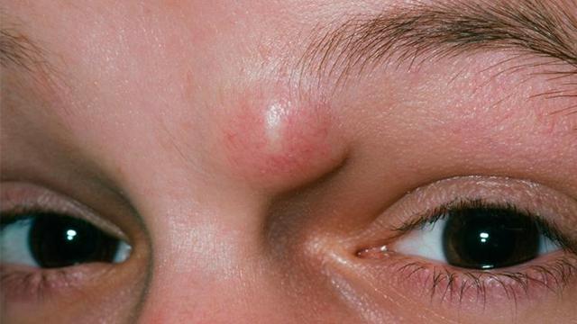 Hausmittel gegen Atherome: Wirksamkeit und Risiken