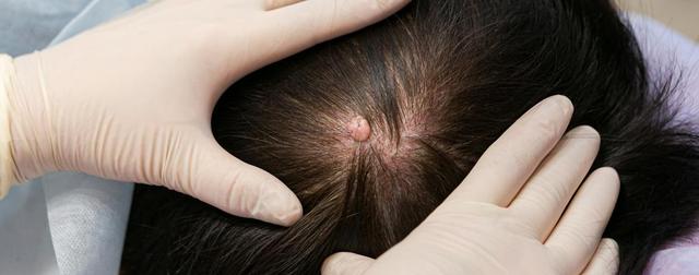 Trichilemmalzysten und Epidermalzysten: Unterschiede und Ursachen