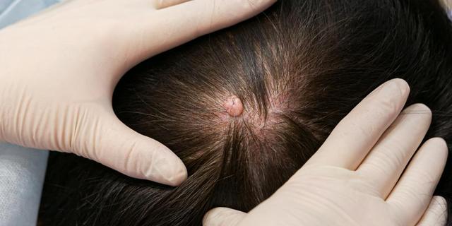 Atherome selbst entfernen: Risiken und Gefahren Atherome selbst entfernen: Risiken und Gefahren