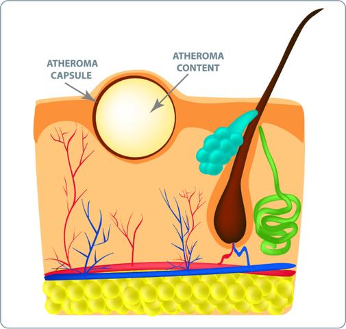 Warum Selbstentfernung von Atheromen riskant ist Warum Selbstentfernung von Atheromen riskant ist