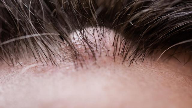 Atherome: Besser nicht selbst behandeln Atherome: Besser nicht selbst behandeln