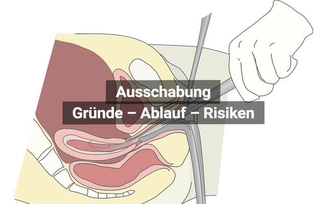 Ausschabung: Wie lange braucht der Körper zur Erholung? Ausschabung: Wie lange braucht der Körper zur Erholung?
