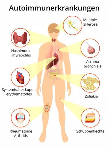 Hautkrankheiten aus dem rheumatoiden Formenkreis: Diagnose und Therapie Hautkrankheiten aus dem rheumatoiden Formenkreis: Diagnose und Therapie