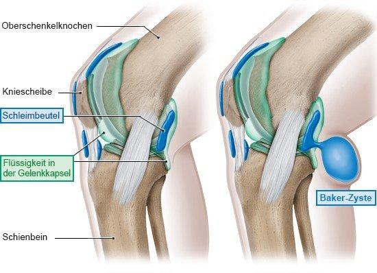 Ursachen und Symptome einer Bakerzyste: Was Sie wissen sollten Ursachen und Symptome einer Bakerzyste: Was Sie wissen sollten