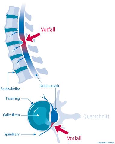 Warum unsere Klinik für Bandscheiben-OPs besonders ist Warum unsere Klinik für Bandscheiben-OPs besonders ist