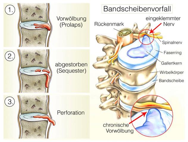 Wann ist eine Bandscheiben-OP notwendig? Indikationen und Symptome Wann ist eine Bandscheiben-OP notwendig? Indikationen und Symptome