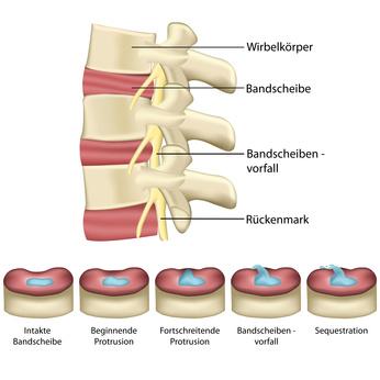 Wie verläuft eine Bandscheiben-OP und was wird dabei gemacht? Wie verläuft eine Bandscheiben-OP und was wird dabei gemacht?