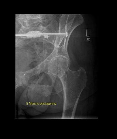 Wie lange muss man nach einem Beckenbruch stationär behandelt werden?