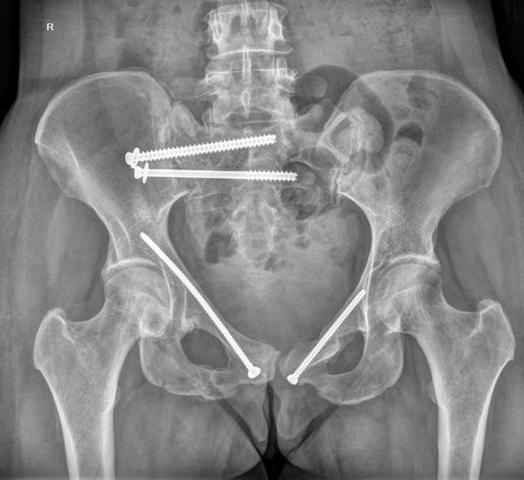 Wie lange dauert der Krankenhausaufenthalt nach einem Beckenbruch?