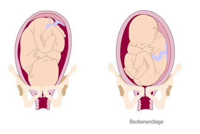 Geburtskomplikationen bei Beckenendlage: Was Sie wissen sollten