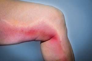 Venenentzündung: Ursachen, Symptome und mögliche Komplikationen