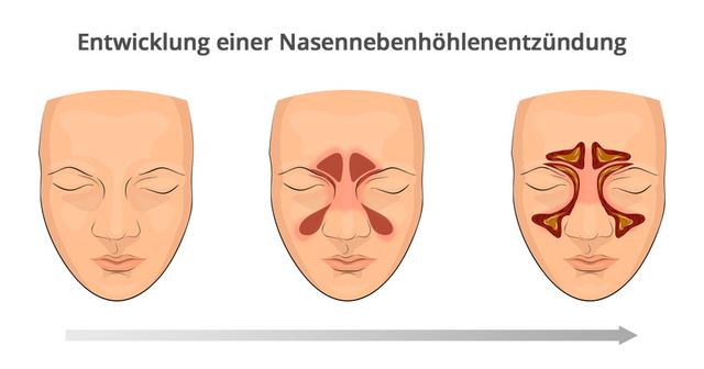 Natürliche Hilfe bei Sinusitis: Natürliche Hilfe bei Sinusitis: