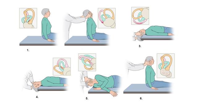 Behandlungsmöglichkeiten für Lagerungsschwindel: Lagerungsmanöver und mehr Behandlungsmöglichkeiten für Lagerungsschwindel: Lagerungsmanöver und mehr
